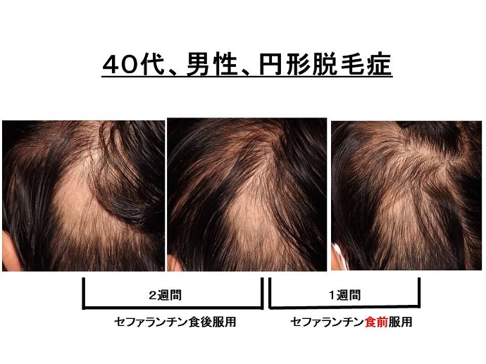 円形脱毛症　病院""